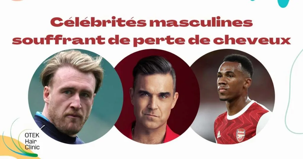 Celebrites masculines souffrant de perte de cheveux