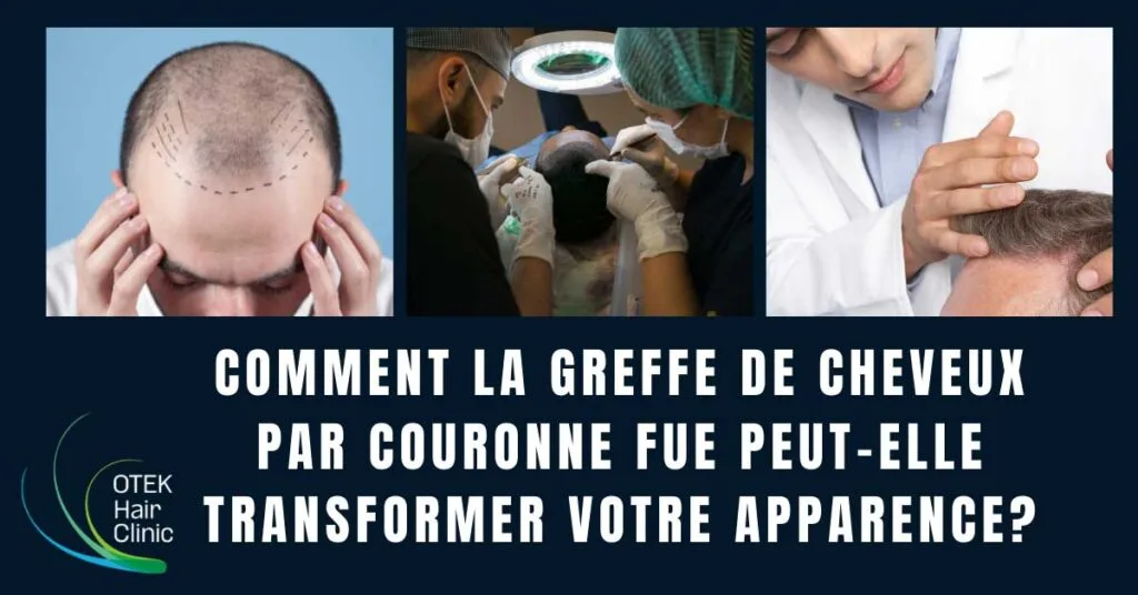 Comment la greffe de cheveux par couronne FUE peut-elle transformer votre apparence? 13 Comment la greffe de cheveux par couronne FUE peut elle transformer votre apparence