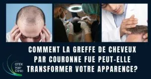 Blog-Fr 38 Comment la greffe de cheveux par couronne FUE peut elle transformer votre apparence