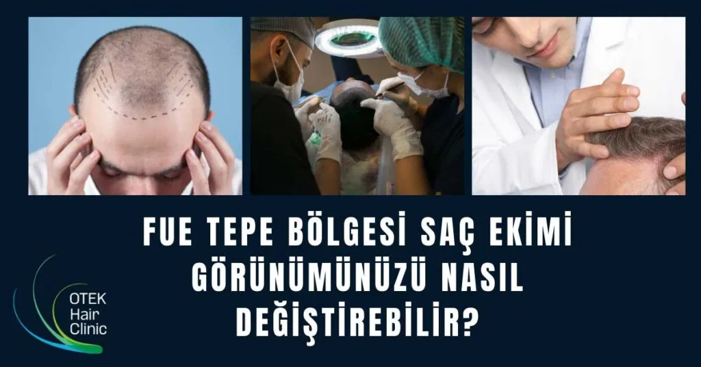 FUE Tepe Bolgesi Sac Ekimi Gorunumunuzu Nasil Degistirebilir