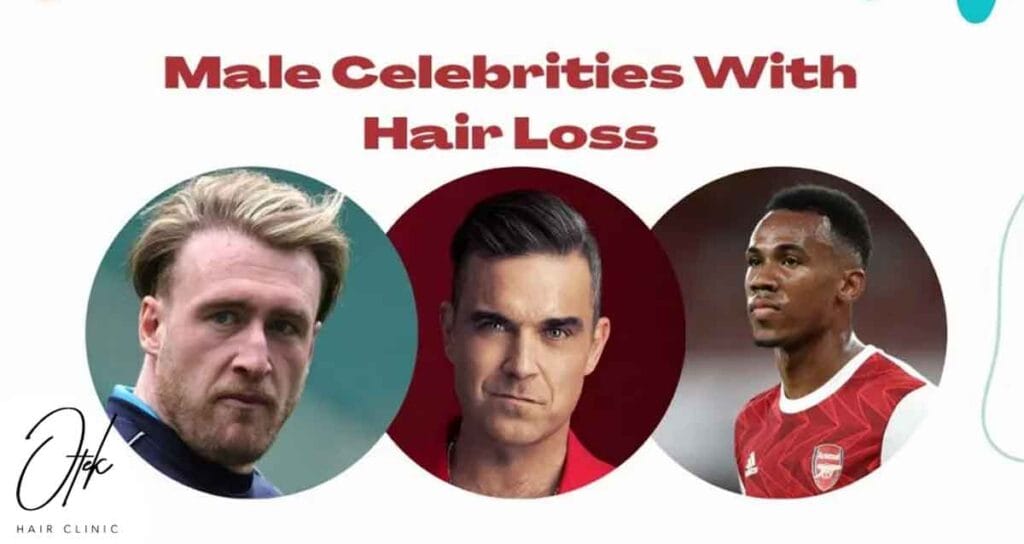 Male Celebrities With Hair Loss 1