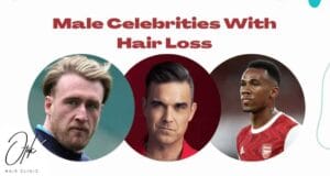 Male Celebrities With Hair Loss 1