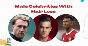 Male Celebrities With Hair Loss
