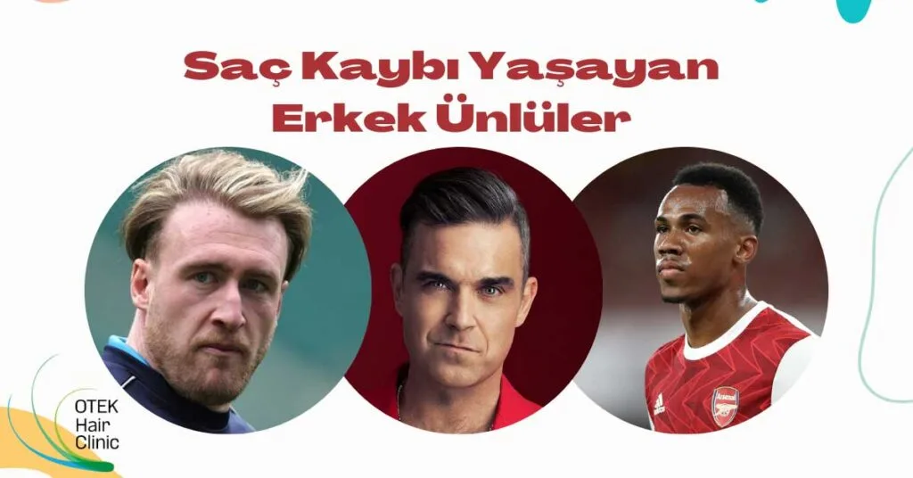 Sac Kaybi Yasayan Erkek Unluler