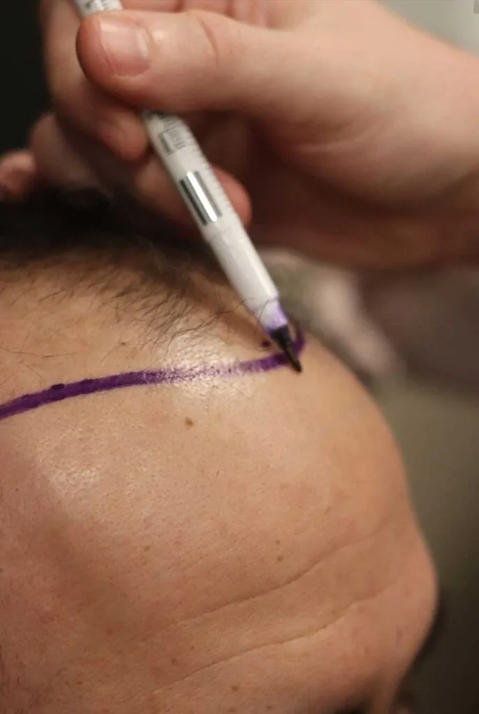 Key Considerations for a Successful Hair Transplant Surgery 3 fue hair transplant otek hair clinic 2