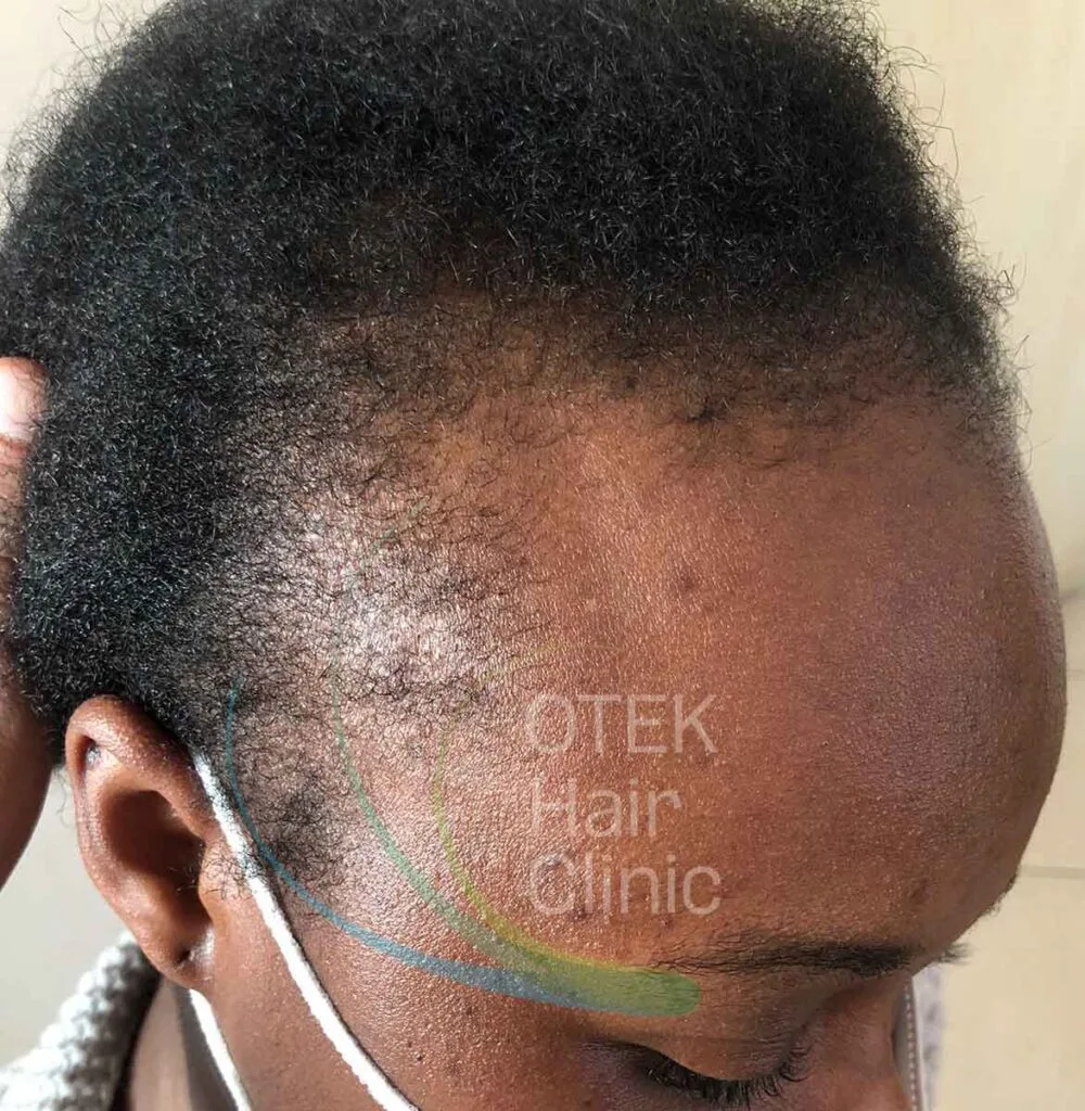 African-American Hair Transplant Procedure 4 otek hair clinic before11