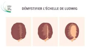 Blog-Fr 35 Comprendre la calvitie feminine demystifier lechelle de Ludwig
