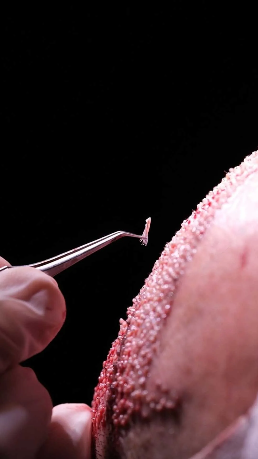 Home 9 DHI hair transplant OTEK hair clinic