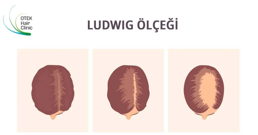 Kadin Tipi Kelligi Anlamak Ludwig Olceginin Gizemini Ortaya Cikarmak