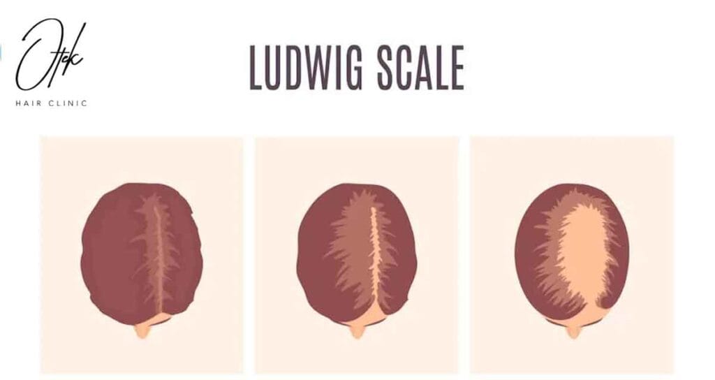 Understanding Female Pattern Baldness Demystifying the Ludwig Scale 1