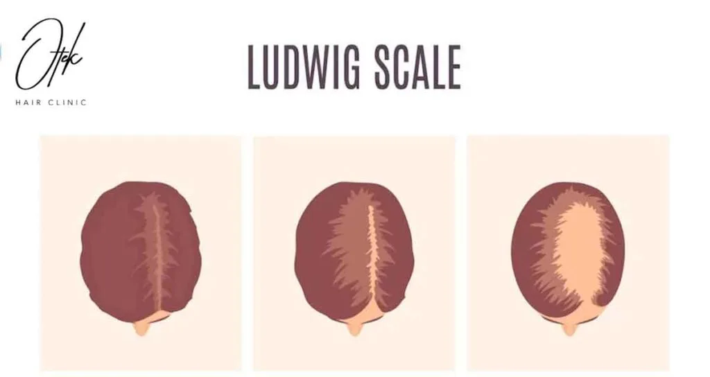Understanding Female Pattern Baldness: Demystifying the Ludwig Scale 17 Understanding Female Pattern Baldness Demystifying the Ludwig Scale 1