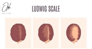 Understanding Female Pattern Baldness Demystifying the Ludwig Scale 1