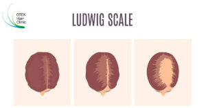Understanding Female Pattern Baldness Demystifying the Ludwig Scale