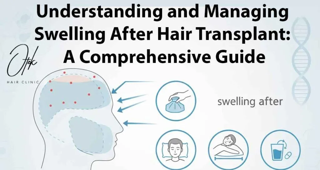 Understanding and Managing Swelling After Hair Transplant: A Comprehensive Guide 16 Understanding and Managing Swelling After Hair Transplant A Comprehensive Guide 1