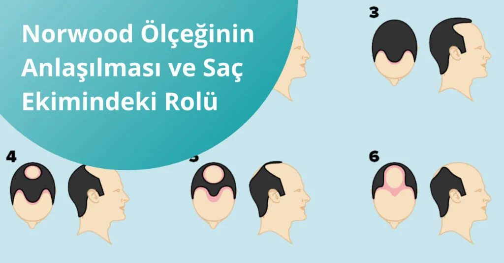 Norwood Olceginin Anlasilmasi ve Sac Ekimindeki Rolu