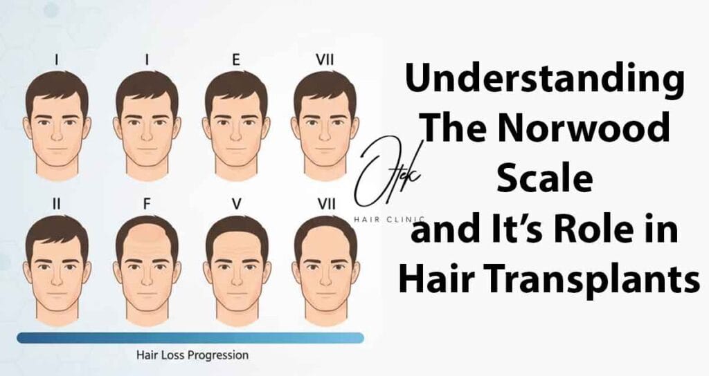 Understanding the Norwood Scale and It's Role in Hair Transplants 2 Understanding the Norwood Scale and Its Role in Hair Transplants 1