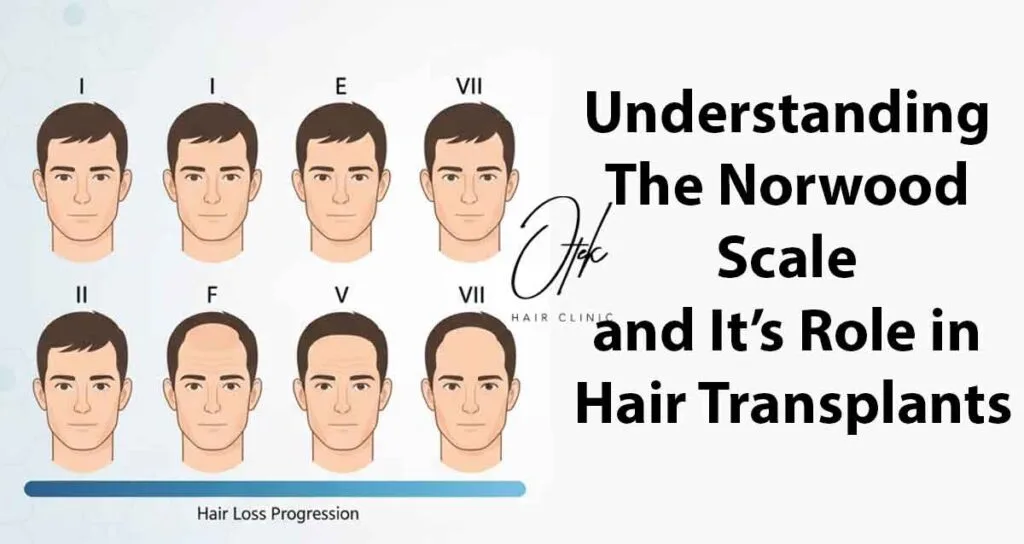 Understanding the Norwood Scale and It's Role in Hair Transplants 12 Understanding the Norwood Scale and Its Role in Hair Transplants 1