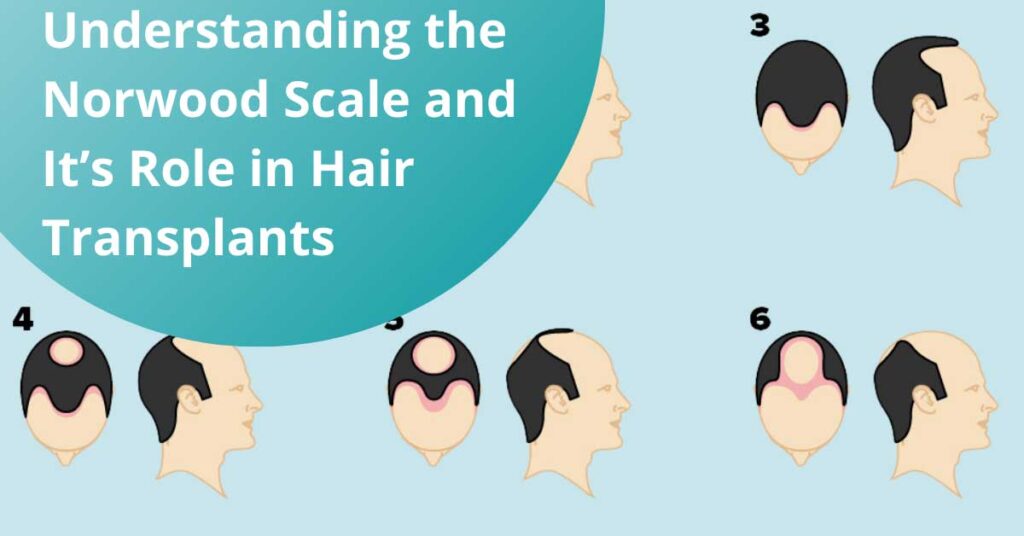 Understanding the Norwood Scale and Its Role in Hair Transplants