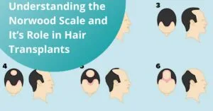 Blog-Fr 33 Understanding the Norwood Scale and Its Role in Hair Transplants