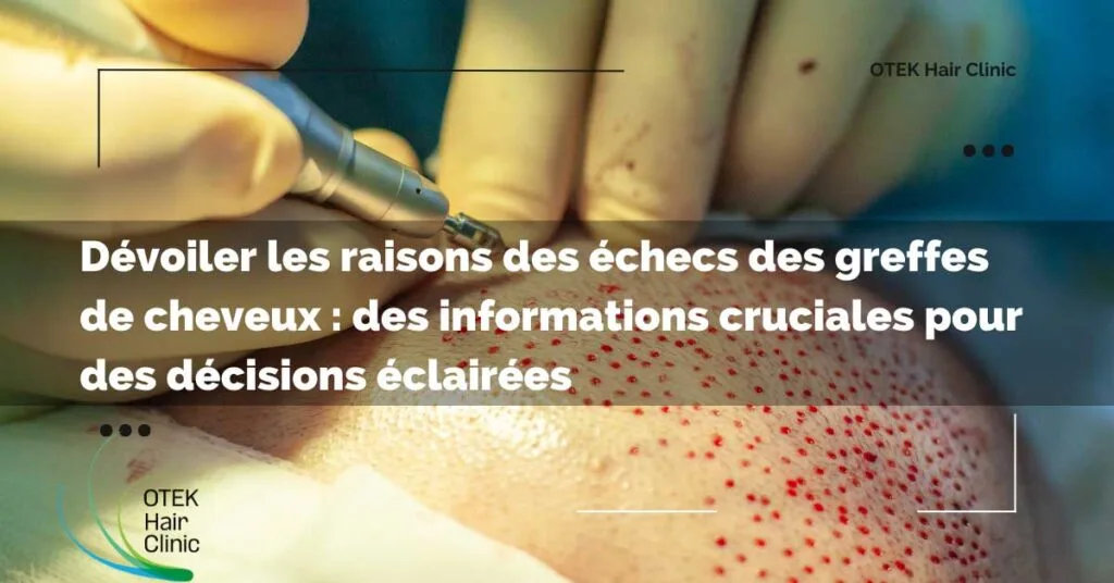 Devoiler les raisons des echecs des greffes de cheveux des informations cruciales pour des decisions eclairees
