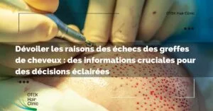 Page D'accueil 59 Devoiler les raisons des echecs des greffes de cheveux des informations cruciales pour des decisions eclairees