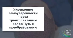 Укрепление самоуверенности через трансплантацию волос Путь к преобразованию