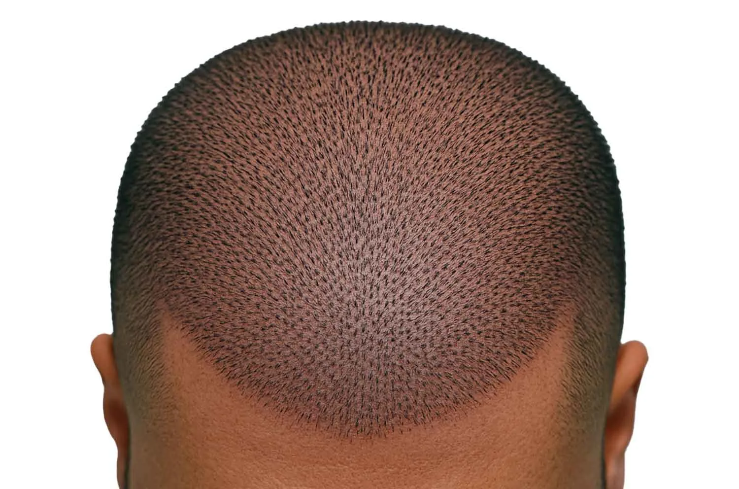 Дом 1 antalya hair transplant otek hair tran.jpg 4