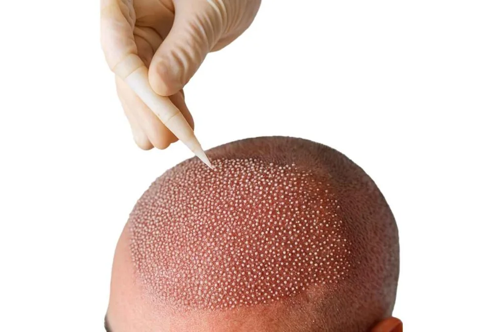 otek hair transplant dhi 1024x677.jpg 1