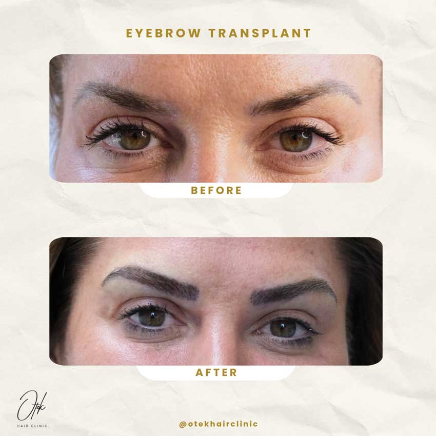 Long FUE Eyebrow Transplant 3 Long FUE eyebrow transplant before and after — Antalya — 2