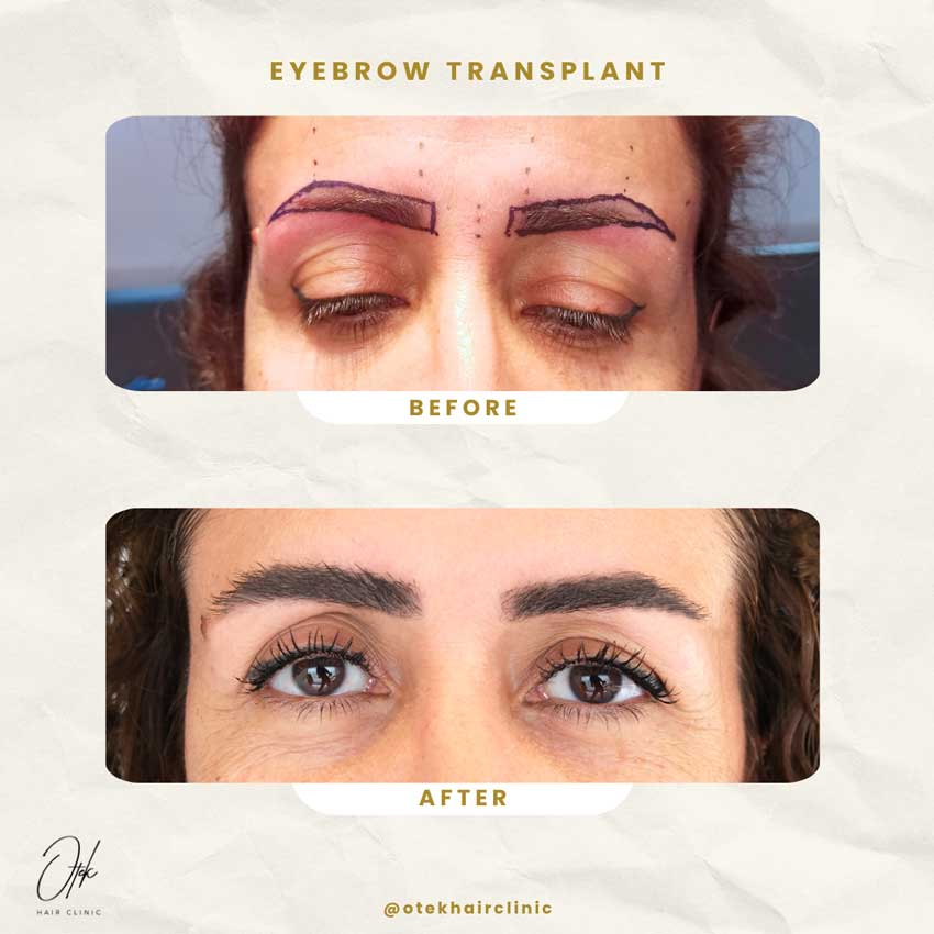Long FUE Eyebrow Transplant 2 Long FUE eyebrow transplant before and after — Antalya — 1