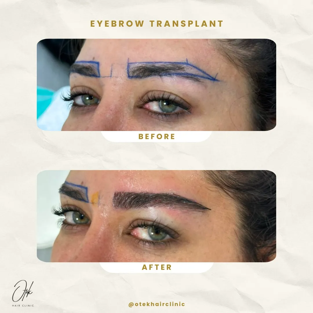 Long FUE eyebrow transplant before and after — OTEK Hair Clinic Antalya — 1