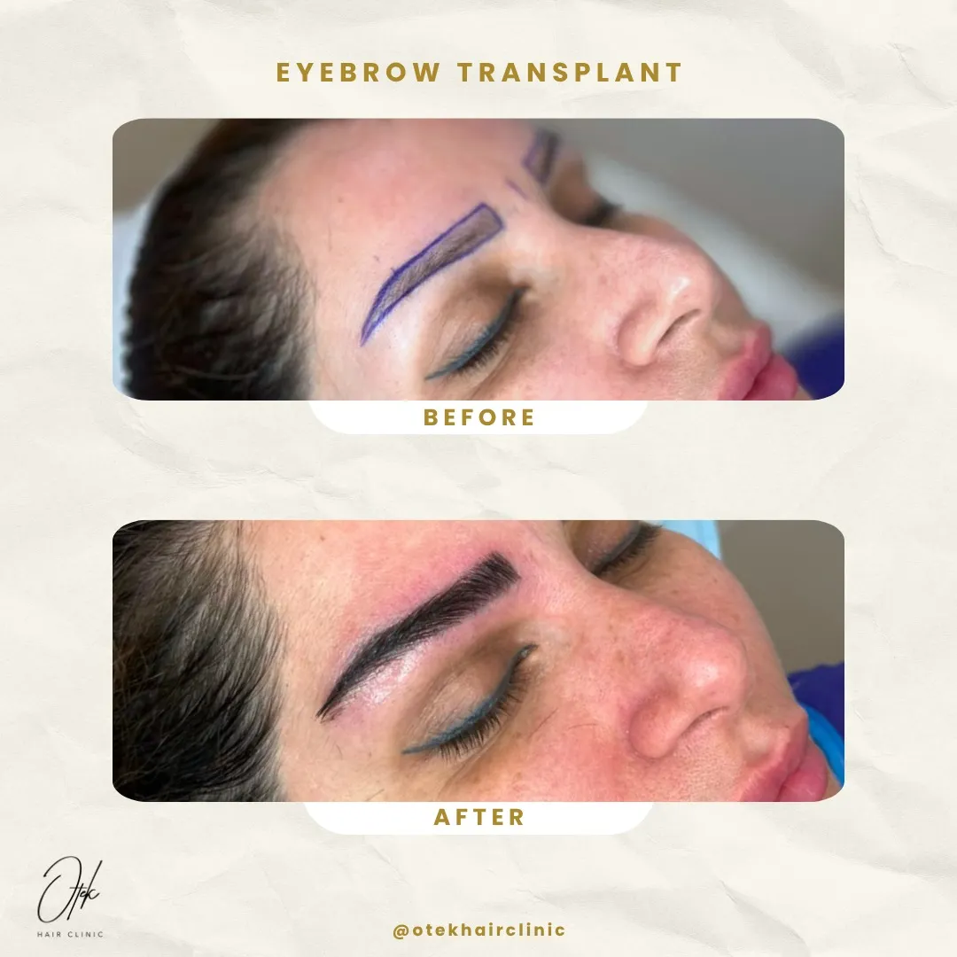 Long FUE eyebrow transplant before and after — OTEK Hair Clinic Antalya — 2