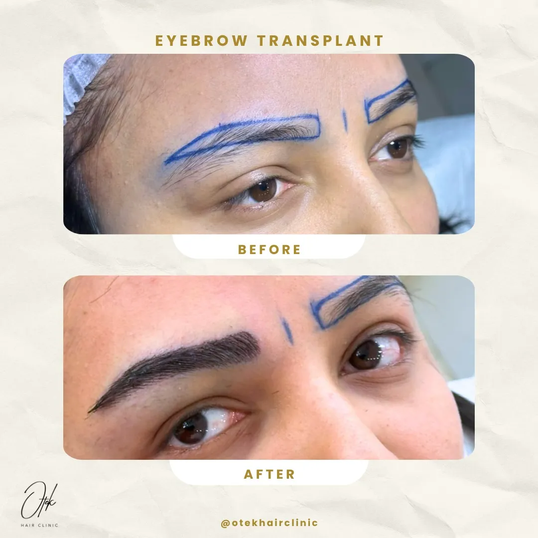 Long FUE eyebrow transplant before and after — OTEK Hair Clinic Antalya — 3