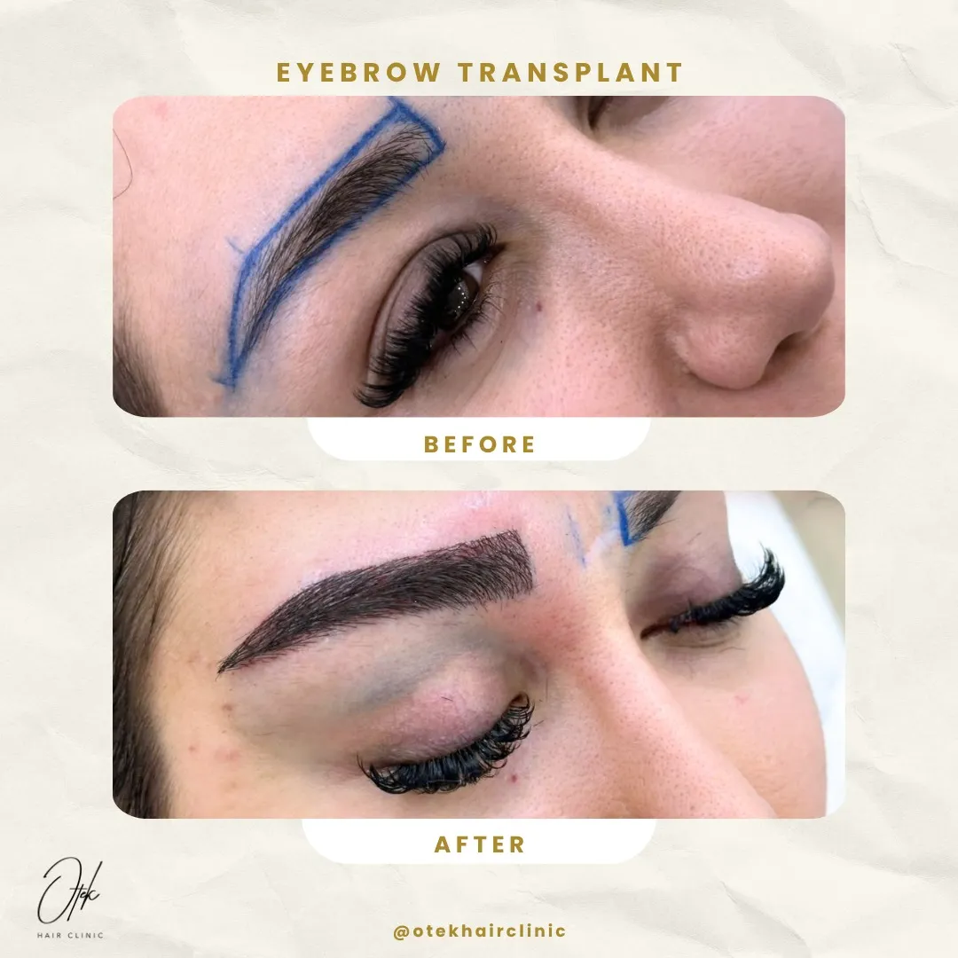Long FUE eyebrow transplant before and after — OTEK Hair Clinic Antalya — 4