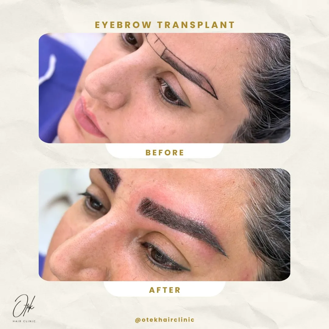 Long FUE eyebrow transplant before and after — OTEK Hair Clinic Antalya — 5