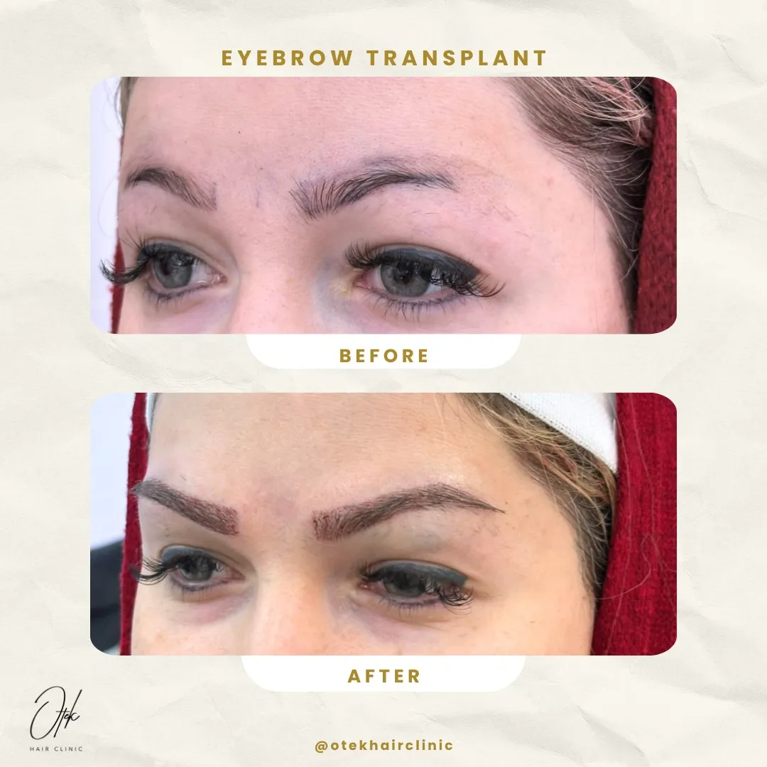 Long FUE eyebrow transplant before and after — OTEK Hair Clinic Antalya — 6