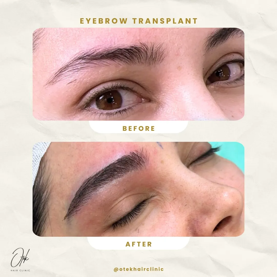Long FUE eyebrow transplant before and after — OTEK Hair Clinic Antalya — 7