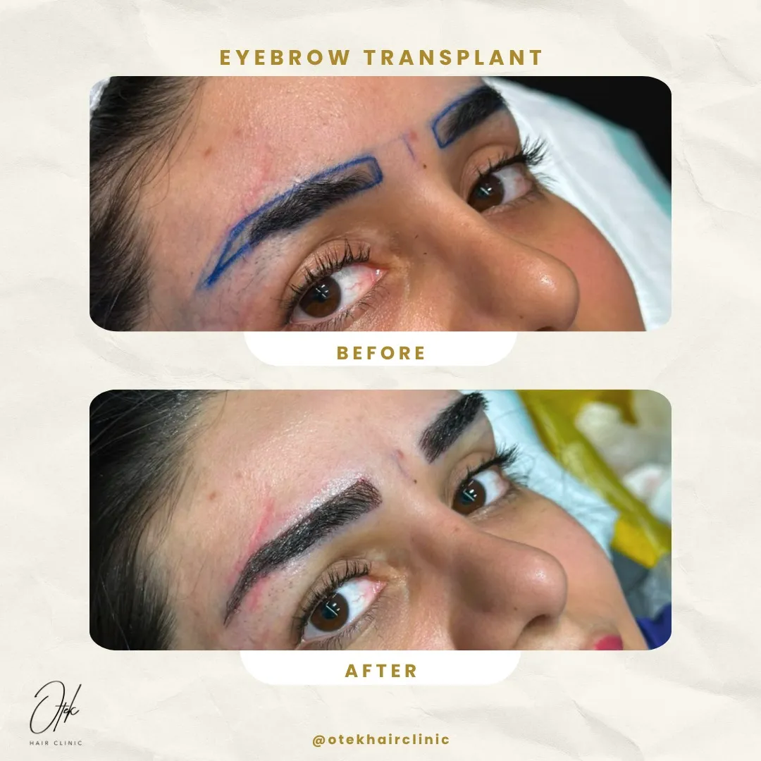 Long FUE eyebrow transplant before and after — OTEK Hair Clinic Antalya — 8